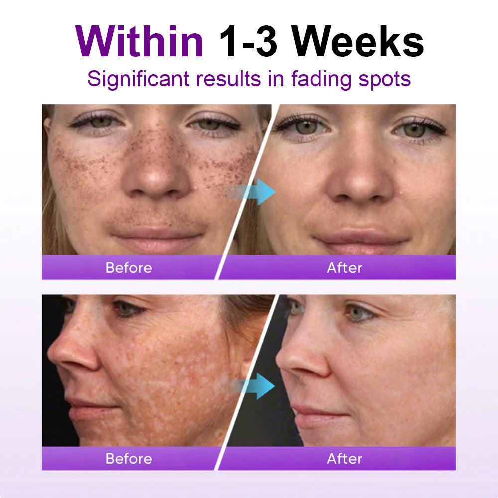 🌟YAGOO® 𝐒𝐩𝐨𝐭𝐄𝐫𝐚𝐬𝐞 𝐏𝐫𝐨𝐛𝐢𝐨𝐭𝐢𝐜 𝐒𝐡𝐢𝐞𝐥𝐝 𝐒𝐞𝐫𝐮𝐦 – Fades Dark Spots, Evens Skin Tone & Boosts Radiance✨💜