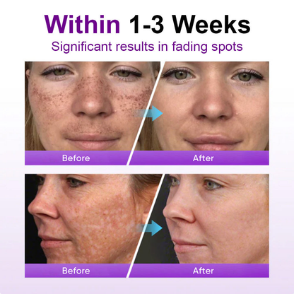 🌟YAGOO® 𝐒𝐩𝐨𝐭𝐄𝐫𝐚𝐬𝐞 𝐏𝐫𝐨𝐛𝐢𝐨𝐭𝐢𝐜 𝐒𝐡𝐢𝐞𝐥𝐝 𝐒𝐞𝐫𝐮𝐦 – Fades Dark Spots, Evens Skin Tone & Boosts Radiance✨💜