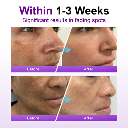 🌟YAGOO® 𝐒𝐩𝐨𝐭𝐄𝐫𝐚𝐬𝐞 𝐏𝐫𝐨𝐛𝐢𝐨𝐭𝐢𝐜 𝐒𝐡𝐢𝐞𝐥𝐝 𝐒𝐞𝐫𝐮𝐦 – Fades Dark Spots, Evens Skin Tone & Boosts Radiance✨💜