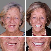 🎄💖Final 3 Hours:50%ОFF💥Yagoo™🦷 YAGOOFirmHold Denture Adhesive — Up to 10 Days of Slip-Free Hold🦷